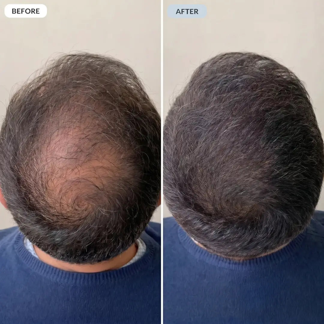 Before and after — crown filling in
