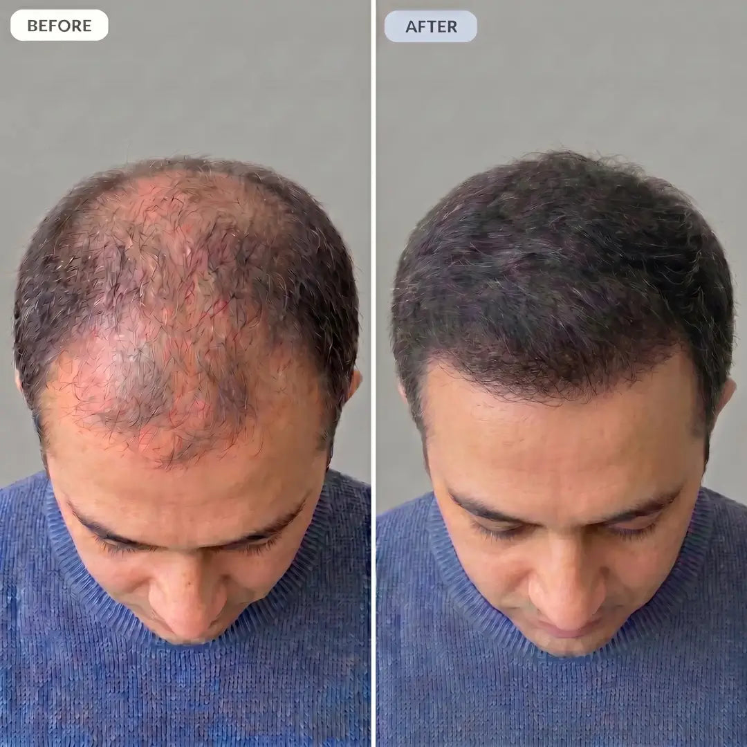 Before and after — hairline regrowth